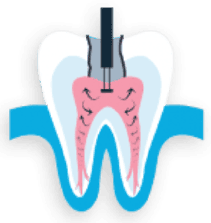 Endodontist in Wesley Chapel